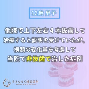 上顎前突、非抜歯、中学生