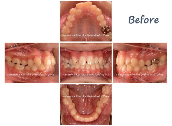 非抜歯、下顎前歯先天性欠如、ワイヤー、拡大、治療前