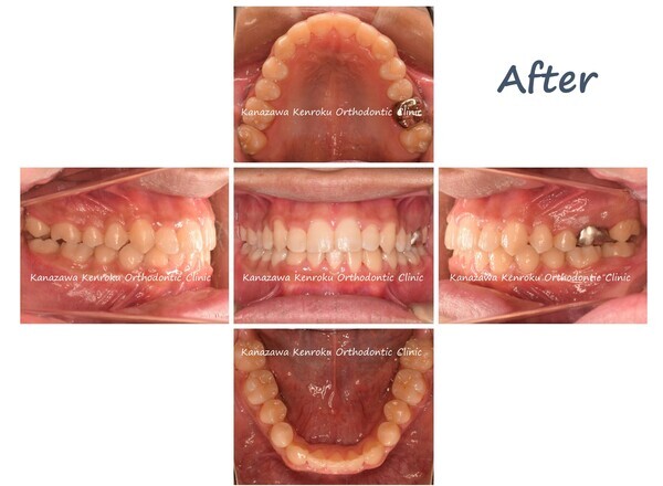 非抜歯、下顎前歯先天性欠如、ワイヤー、拡大、治療後