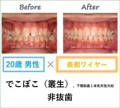 非抜歯、下顎前歯先天性欠如、ワイヤー、拡大