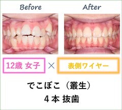 抜歯、治療期間が短い、１年４か月、ワイヤー矯正、比較。