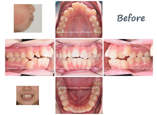 抜歯、治療期間が短い、１年４か月、ワイヤー矯正、治療前