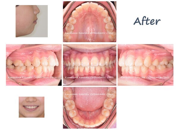 抜歯、治療期間が短い、１年４か月、ワイヤー矯正、治療後