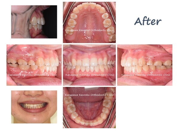 抜歯、治療期間が短い、１年６か月、開咬、叢生、ワイヤー矯正、治療後