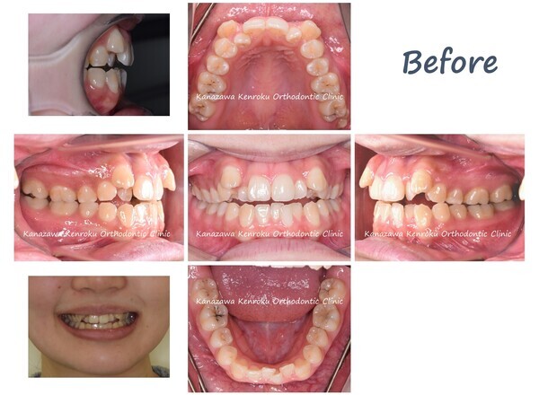 抜歯、治療期間が短い、１年６か月、開咬、叢生、ワイヤー矯正、治療前