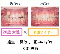 抜歯、治療期間が短い、１年６か月、開咬、叢生、ワイヤー矯正、比較