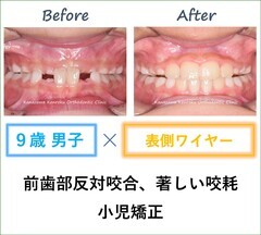 前歯部反対咬合、著しい咬耗による過蓋咬合、比較