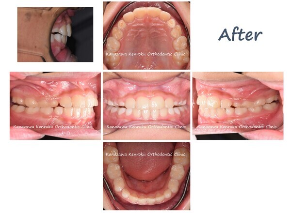 前歯部反対咬合、著しい咬耗による過蓋咬合、治療後