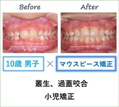 治療事例｜石川県金沢市の矯正歯科なら金沢けんろく矯正歯科
