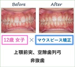 マウスピース矯正（Invisalign）で上顎前突と空隙歯列を改善した12歳女子の治療前後比較