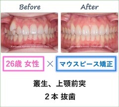 インビザラインで上顎２本抜歯をして主訴を改善した26歳女性の治療前後比較