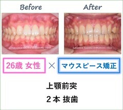 インビザラインで上顎2本抜歯をして出っ歯を改善した26歳女性の治療前後比較