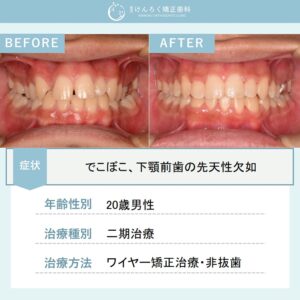 下顎前歯の先天性欠如と上顎の叢生を非抜歯で治したケース