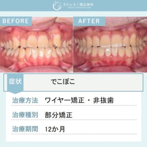 19歳男性：部分矯正で叢生を改善したケース