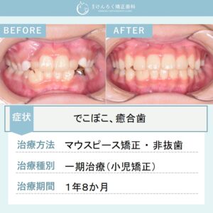 ９歳女子：叢生を改善しつつ右下の癒合歯を含めて永久歯列を想定して咬合誘導したケース