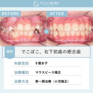 叢生を改善しつつ右下の癒合歯を含めて永久歯列を想定して咬合誘導したケース