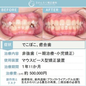 ９歳女子：叢生を改善しつつ右下の癒合歯を含めて永久歯列を想定して咬合誘導したケース