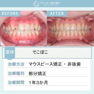 23歳女性：前歯のでこぼこをマウスピース矯正（インビザライン）で非抜歯で治したケース
