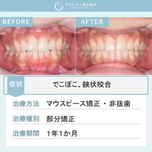 21歳女性：ワイヤー矯正とマウスピース矯正（インビザライン）のコンビネーションにて非抜歯で治したケース
