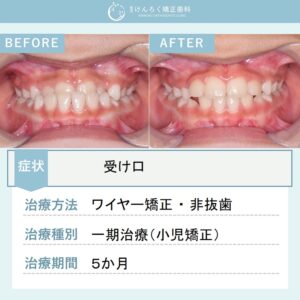 ８歳女子：下顎前突（反対咬合）をワイヤー矯正で治したケース