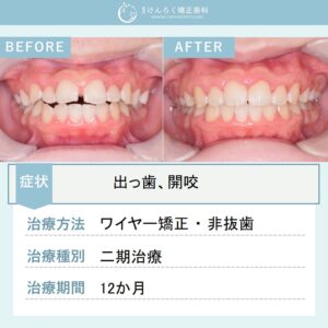 12歳男子：他院で４本抜歯と説明を受けたけど抜きたくないという希望を叶えたケース