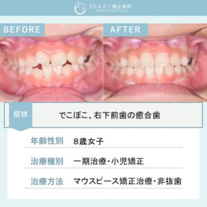 前歯のでこぼこをお子さまのマウスピース矯正装置で治したケース