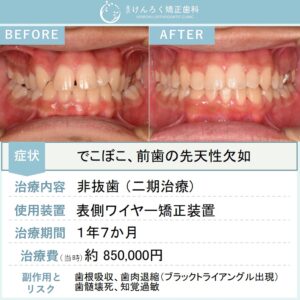 20歳男性：下顎前歯の先天性欠如と上顎の叢生を非抜歯で治したケース