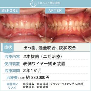15歳男子：歯科検診で指摘された過蓋咬合を上顎２本抜歯で治したケース