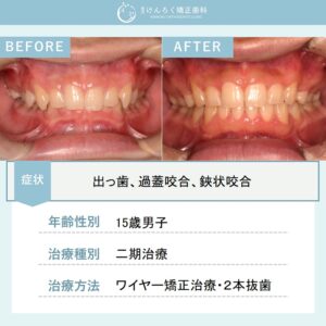 歯科検診で指摘された過蓋咬合を上顎2本抜歯で治したケース