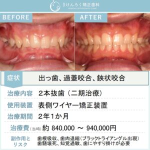 15歳男子：歯科検診で指摘された過蓋咬合を上顎２本抜歯で治したケース