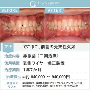 20歳男性：下顎前歯の先天性欠如と上顎の叢生を非抜歯で治したケース