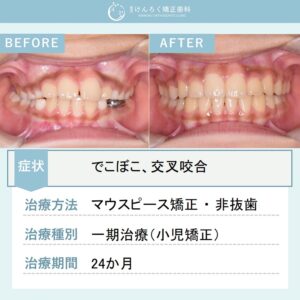 ９歳男子：永久歯萌出スペース獲得と歯列正中の是正を小児のマウスピース矯正で行ったケース