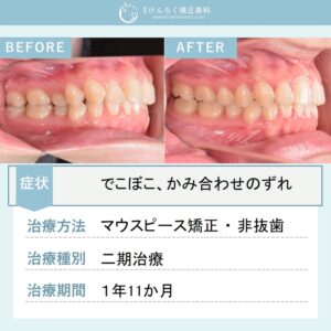 24歳女性：マウスピース矯正（インビザライン）にて上顎大臼歯の遠心移動を行い、叢生を非抜歯で治したケース