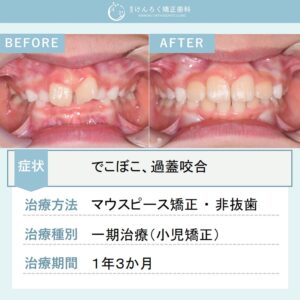 ８歳女子：前歯のでこぼことかみ合わせの深さを小児のマウスピース矯正で治したケース