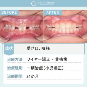 ９歳男子：受け口を主訴に来院された著しい咬耗を伴う前歯部反対咬合および過蓋咬合をワイヤー矯正で治したケース