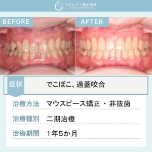 50歳女性：マウスピース矯正（インビザライン）にて叢生を非抜歯で治療したケース