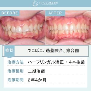 23歳女性：ハーフリンガル矯正装置で抜歯により叢生を改善したケース