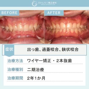 15歳男子：歯科検診で指摘された過蓋咬合を上顎２本抜歯で治したケース
