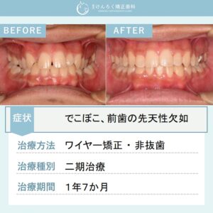 20歳男性：下顎前歯の先天性欠如と上顎の叢生を非抜歯で治したケース