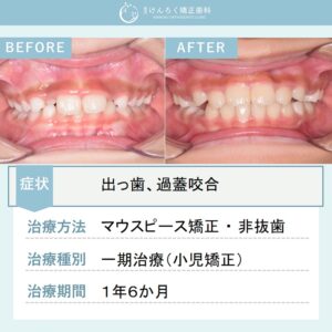 ９歳女子：小児のマウスピース矯正で永久歯萌出スペースの確保と過蓋咬合を改善したケ－ス