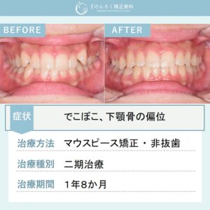 15歳女子：マウスピース矯正（インビザライン）にて叢生を非抜歯で治したケース