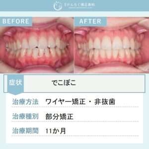30歳女性：部分矯正で前歯１本の突出を改善したケース