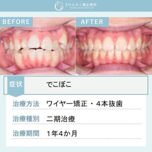 12歳女子：でこぼこを上下左右の第一小臼歯を４本抜歯して１年４か月という短期間で治したケースさい