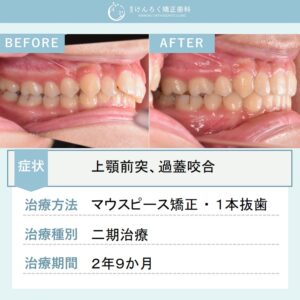 14歳女子：前歯のでこぼことかみ合わせのずれをマウスピース型矯正装置（インビザライン）で治したケース