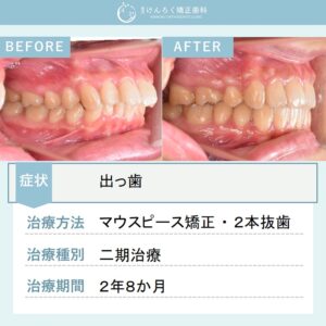 26歳女性：マウスピース矯正（インビザライン）にて上顎前突を小臼歯２本抜歯で治したケース