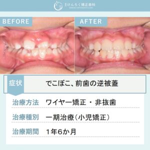 ８歳男子：小児矯正で前歯のでこぼこ（中切歯の逆被蓋あり）をワイヤー矯正で治したケース