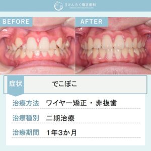 12歳男子：でこぼことかみ合わせのズレを患者さまの成長を利用して当院で非抜歯で治したケース