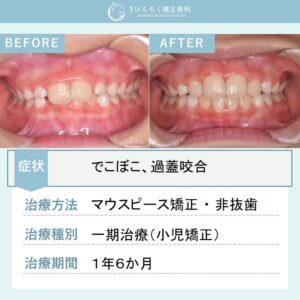 10歳男子：小児矯正で前歯のでこぼこをマウスピース矯正装置（インビザライン）で治したケース