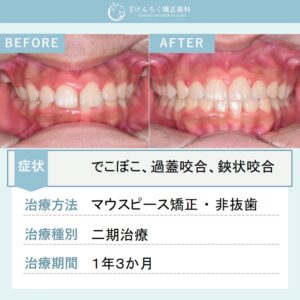 16歳男子：上顎前突、過蓋咬合および両側第二大臼歯の鋏状咬合をマウスピース矯正で非抜歯で治療したケース