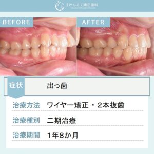 19歳女性：マルチブラケット装置（唇側）で上顎前突を治したケース